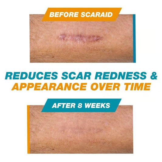 Skin Scar Solutions?️ 60% Silicone Scar Stick.